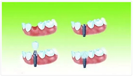 種植牙常見問答你知道多少？