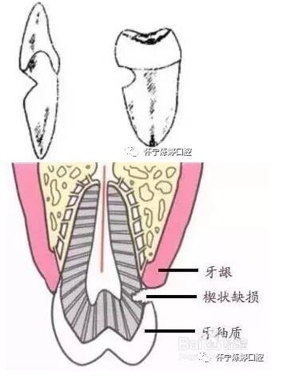 什么是牙齒楔缺？