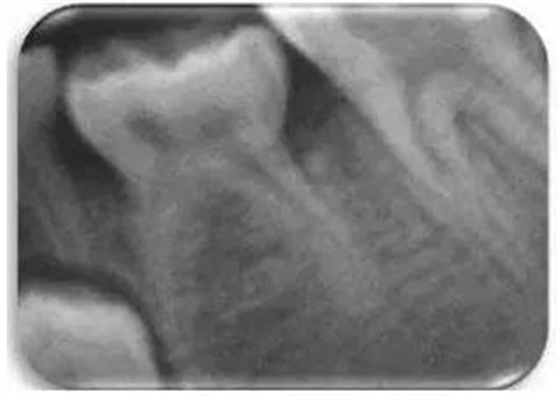 文獻(xiàn)直達(dá)｜一項(xiàng)西班牙的研究：低位乳磨牙的發(fā)生頻率、程度、牙根吸收和前磨牙發(fā)育不全情況