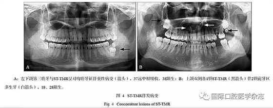 46例患者第三磨牙區(qū)多生牙的影像學(xué)分析