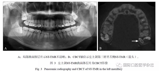 46例患者第三磨牙區(qū)多生牙的影像學(xué)分析