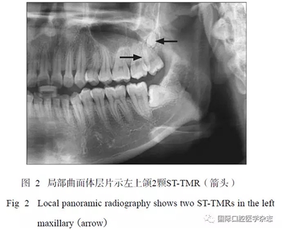 46例患者第三磨牙區(qū)多生牙的影像學(xué)分析
