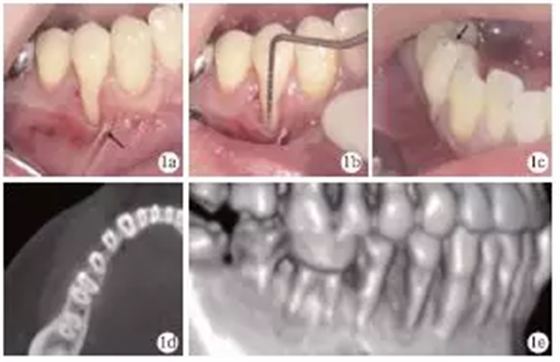 側(cè)向轉(zhuǎn)位瓣結(jié)合上皮下結(jié)締組織移植治療重度MillerⅢ°牙齦退縮1例