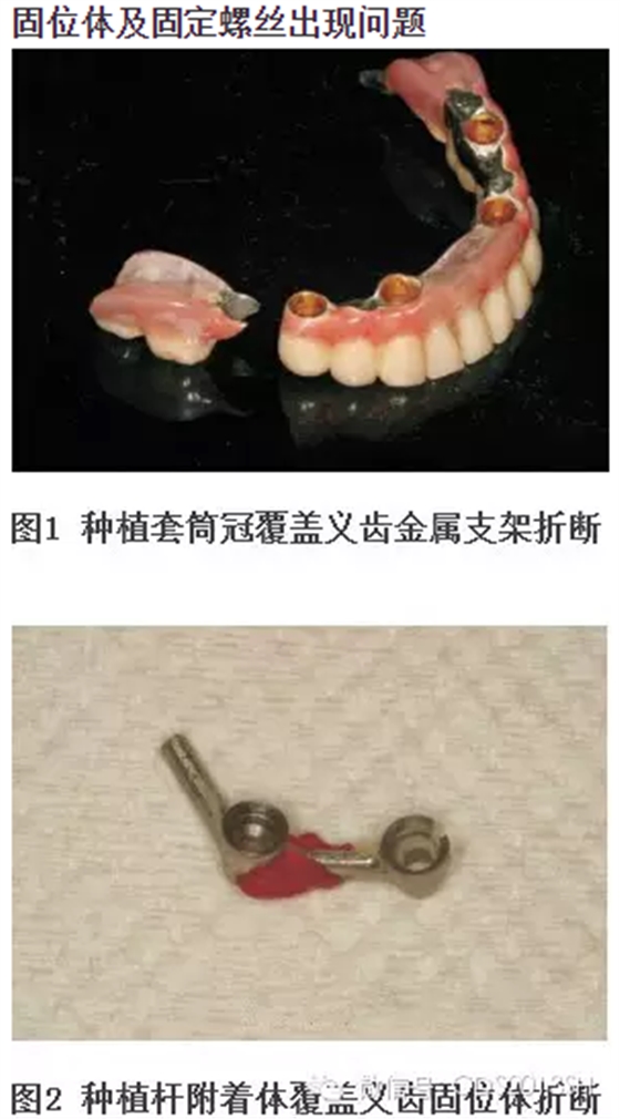 【經(jīng)驗分享】無牙頜種植修復(fù)固位的并發(fā)癥與處理——宋應(yīng)亮教授