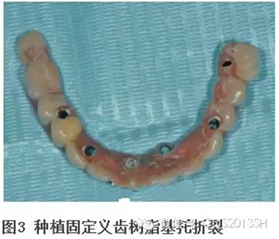 【經(jīng)驗分享】無牙頜種植修復(fù)固位的并發(fā)癥與處理——宋應(yīng)亮教授