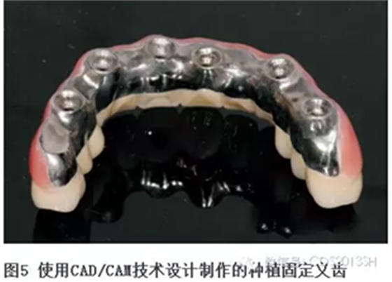 【經(jīng)驗分享】無牙頜種植修復(fù)固位的并發(fā)癥與處理——宋應(yīng)亮教授