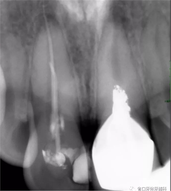 上前牙根管再治療后內(nèi)漂白1例