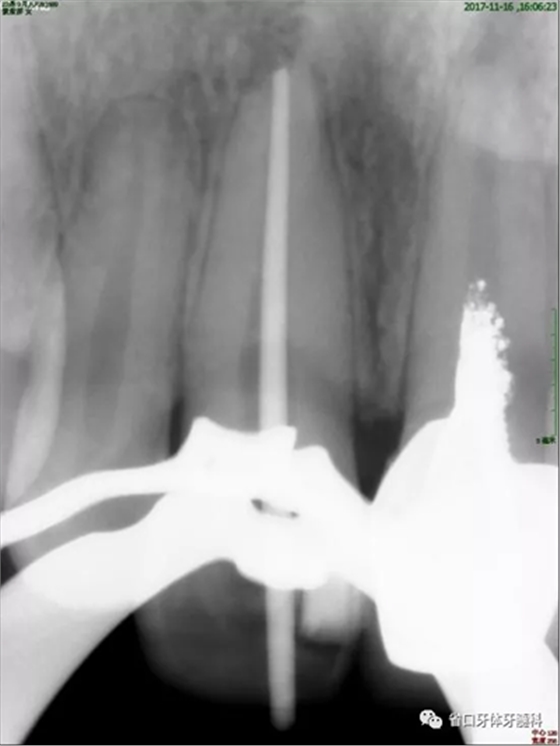 上前牙根管再治療后內(nèi)漂白1例
