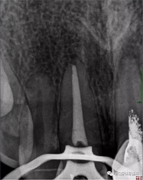 上前牙根管再治療后內(nèi)漂白1例