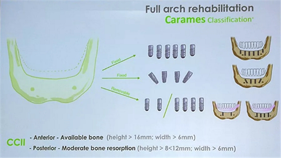 【熱點(diǎn)回顧】帶您深度了解無牙頜種植修復(fù)——Pro Arch