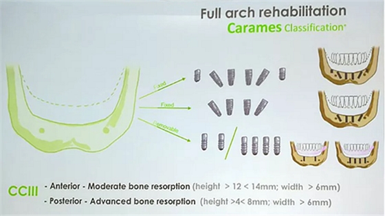 【熱點(diǎn)回顧】帶您深度了解無牙頜種植修復(fù)——Pro Arch