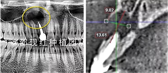 「科普篇」你真的了解它嗎？——β-磷酸三鈣