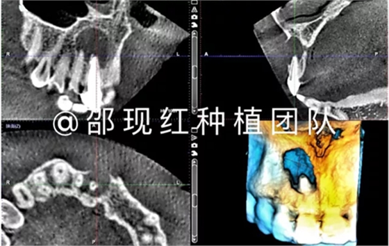 「科普篇」你真的了解它嗎？——β-磷酸三鈣