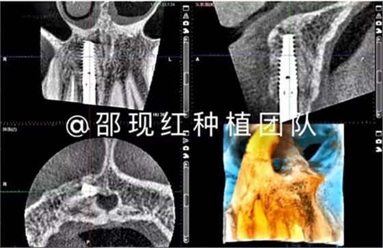 「科普篇」你真的了解它嗎？——β-磷酸三鈣