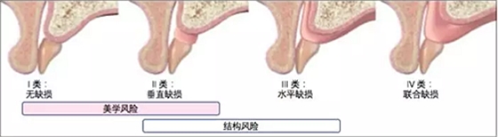 【文獻(xiàn)精讀】唇-齒-牙槽嵴分類：無牙頜上頜牙弓指南。診斷，風(fēng)險(xiǎn)評(píng)估及種植治療指征