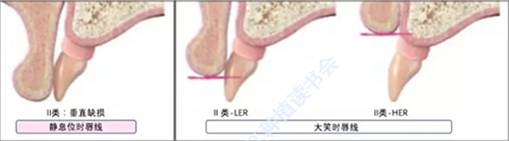 【文獻(xiàn)精讀】唇-齒-牙槽嵴分類：無牙頜上頜牙弓指南。診斷，風(fēng)險(xiǎn)評(píng)估及種植治療指征