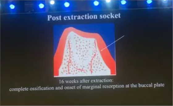 【聽課筆記】拔牙后位點的軟硬組織處理