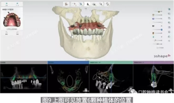 病例報(bào)道│全程數(shù)字化輔助無(wú)牙頜種植即刻負(fù)重