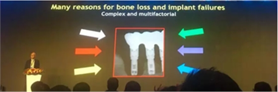 【聽(tīng)課筆記】種植體周圍骨吸收因素研究與臨床意義