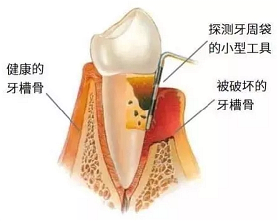 上海嘉?？谇谎芯克皇兰o牙周病的臨床進展