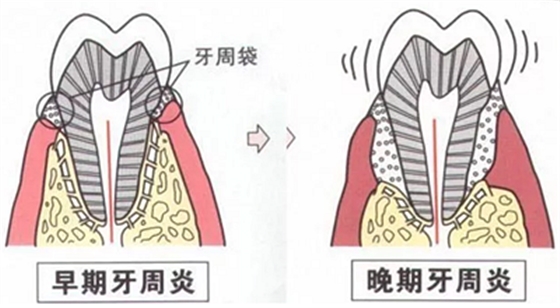 上海嘉?？谇谎芯克皇兰o牙周病的臨床進展