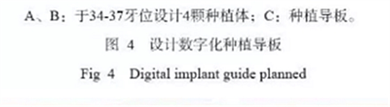 下頜骨腓骨移植聯(lián)合牙種植術(shù)后的覆蓋義齒修復(fù)1例