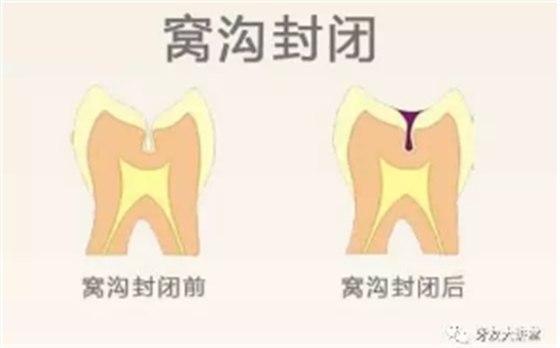 兒童防齲齒【窩溝封閉】和【涂氟】是一回事兒嗎？