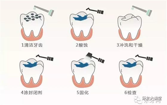 兒童防齲齒【窩溝封閉】和【涂氟】是一回事兒嗎？