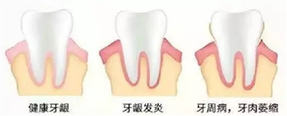 牙周炎，中國成年人后半生永遠(yuǎn)的 痛 ！