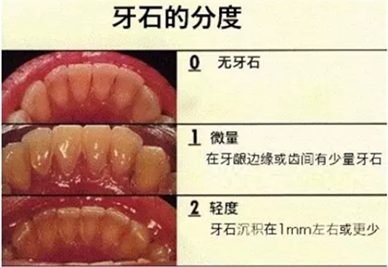 牙周炎，中國成年人后半生永遠(yuǎn)的 痛 ！