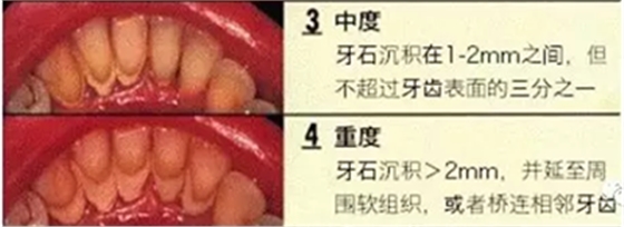 牙周炎，中國成年人后半生永遠(yuǎn)的 痛 ！