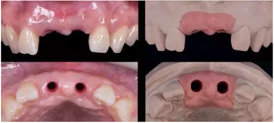 Asc全瓷角度基臺一體冠進(jìn)行種植前牙美學(xué)修復(fù)一例