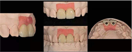 Asc全瓷角度基臺一體冠進(jìn)行種植前牙美學(xué)修復(fù)一例