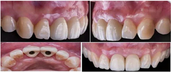 Asc全瓷角度基臺一體冠進(jìn)行種植前牙美學(xué)修復(fù)一例