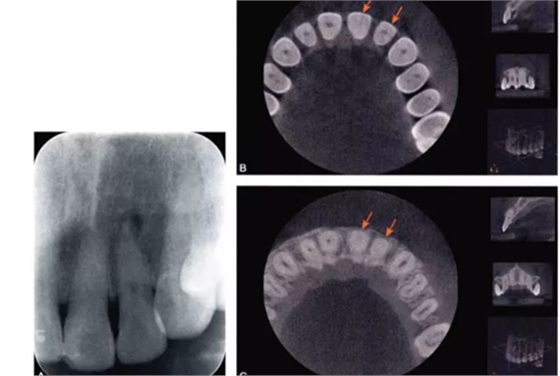 （六期）細(xì)小鈣化根管的疏通——病因及診斷