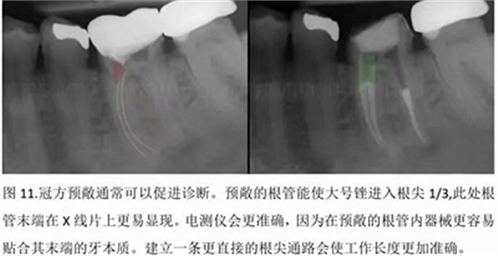 【病例分享】根管冠部預(yù)敞