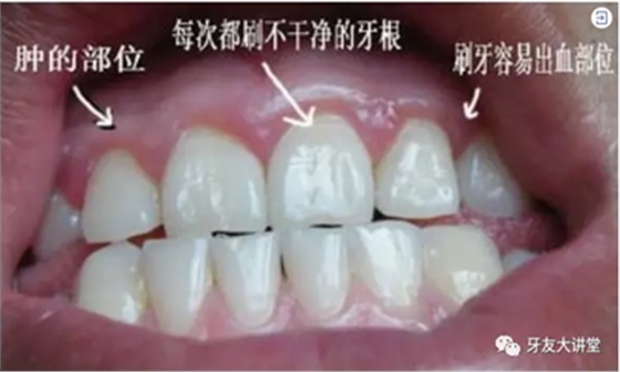 怎樣預防牙齦萎縮