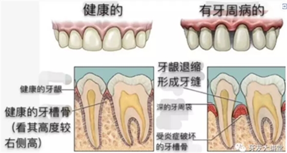 怎樣預防牙齦萎縮