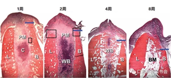 血液衍生物PRF&CGF在牙槽窩處理中的應(yīng)用