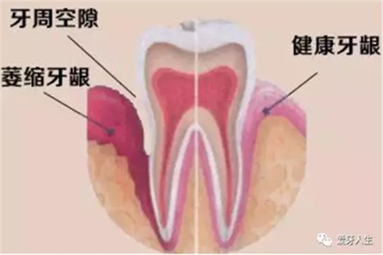 牙齦萎縮怎么辦？