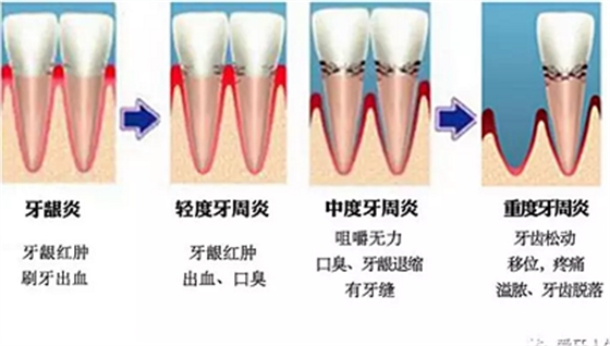 牙齦萎縮怎么辦？