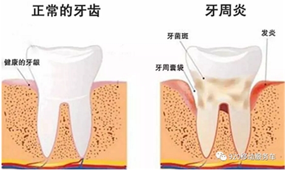 牙齦萎縮怎么辦？