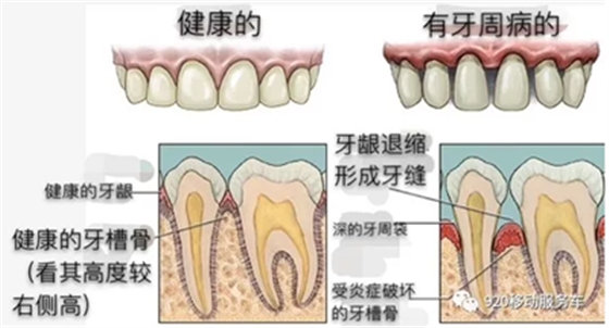 牙齦萎縮怎么辦？