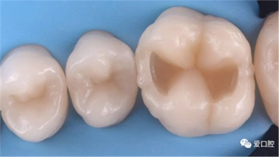 復(fù)合樹脂直接粘接牙體修復(fù)技術(shù)臨床常見問題及處理