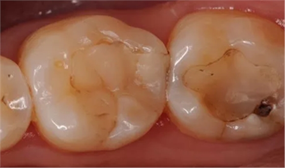 復(fù)合樹脂直接粘接牙體修復(fù)技術(shù)臨床常見問題及處理