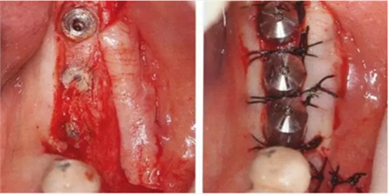 種植體周圍角化齦的獲得時期與方法