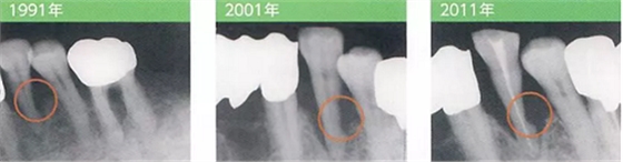 牙周探診SRP