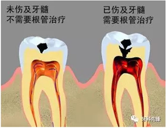 補(bǔ)牙不做冠，療效少一半！根管治療后牙齒已經(jīng)不疼了，為什么還要戴牙冠呢？