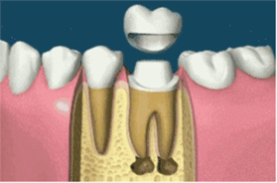 補(bǔ)牙不做冠，療效少一半！根管治療后牙齒已經(jīng)不疼了，為什么還要戴牙冠呢？