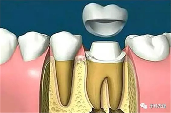 補(bǔ)牙不做冠，療效少一半！根管治療后牙齒已經(jīng)不疼了，為什么還要戴牙冠呢？